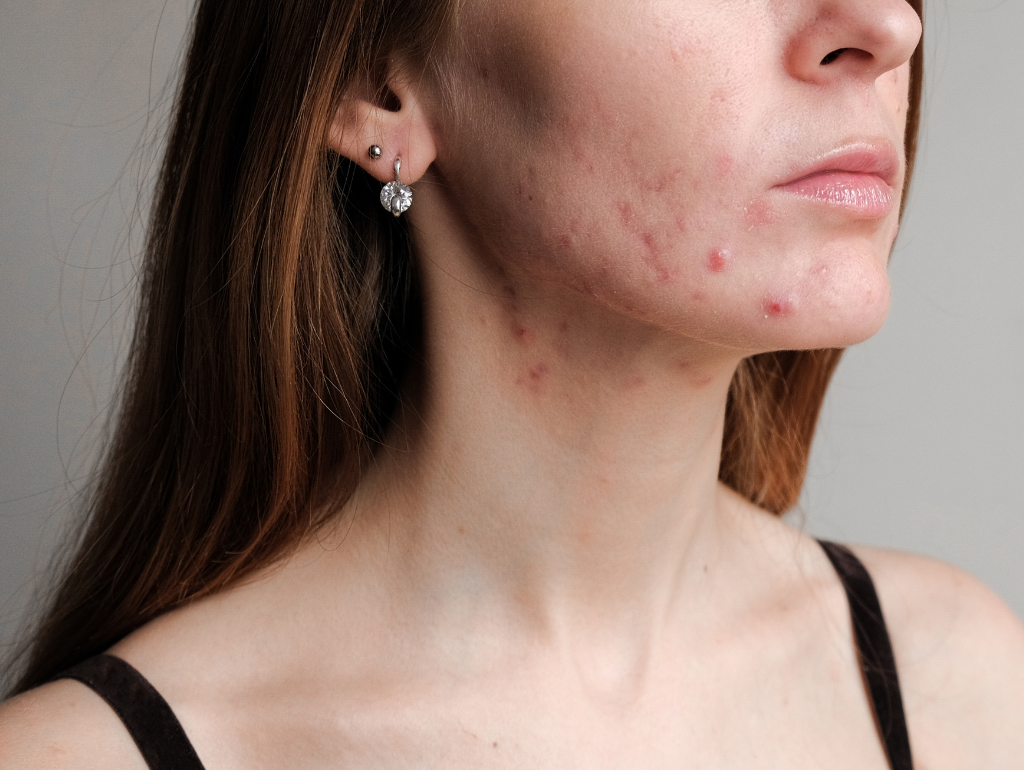Spot Solutions: Tackling Occasional Breakouts Without Disrupting Your Skin Barrier