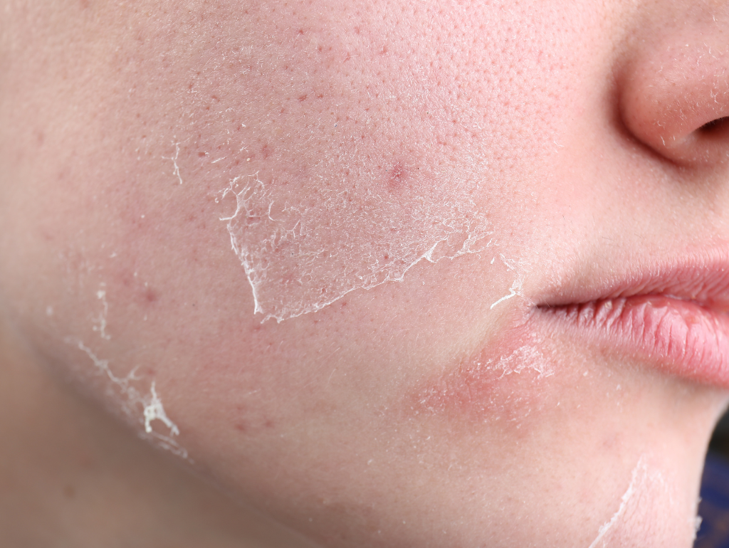 Common Mistakes to Avoid with Dry Skin