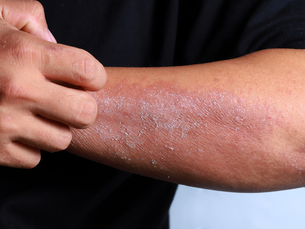 Dealing with Flakiness: Skincare Tips for Dry Skin