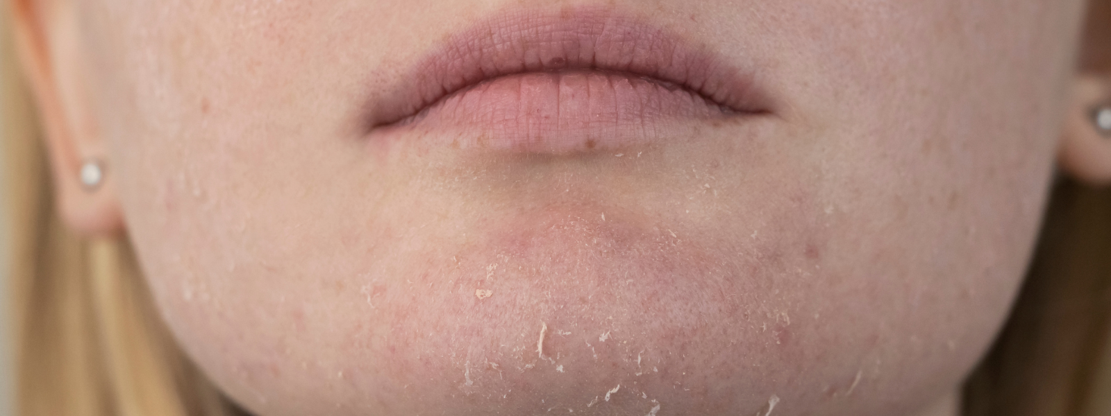 How to Balance Oily and Dry Areas on Combination Skin