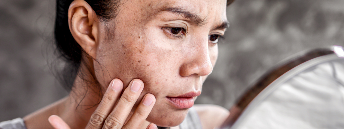 How to Treat Hyperpigmentation and Dark Spots