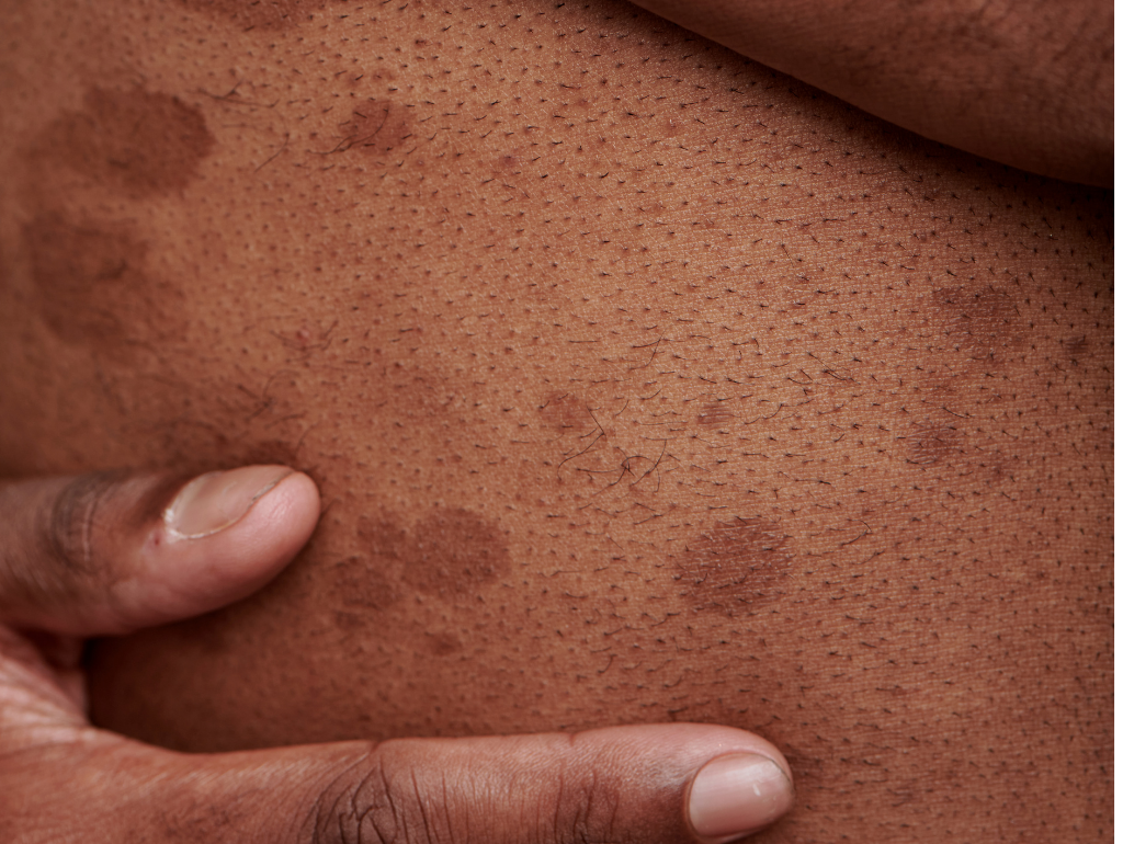 Understanding Post-Inflammatory Hyperpigmentation – mosaique