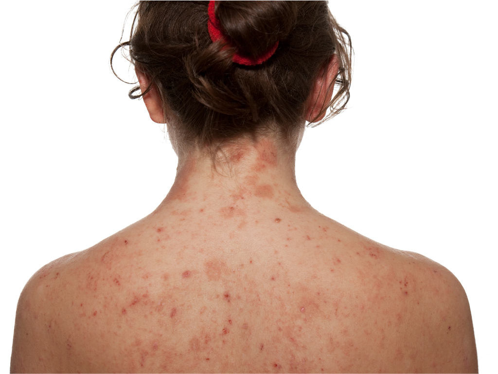 Addressing Eczema and Psoriasis in Various Climates