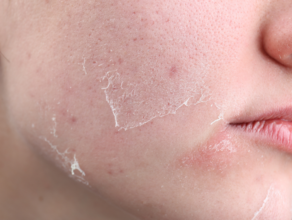 Flakiness: When Your Skin Becomes a Snow Globe