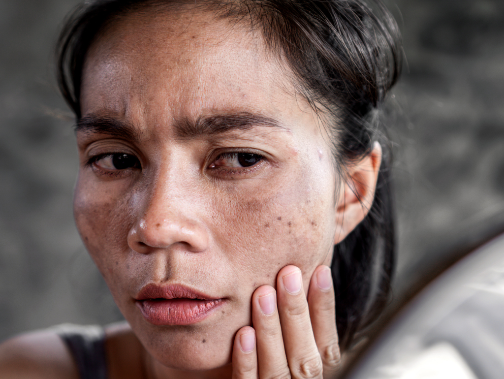 Hyperpigmentation (Dark Spots): When Your Skin Tells Stories You'd Rather Forget