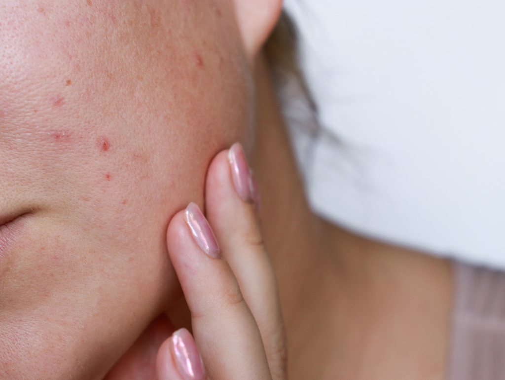 PIH (Acne Scars): When Breakouts Leave Lasting Souvenirs