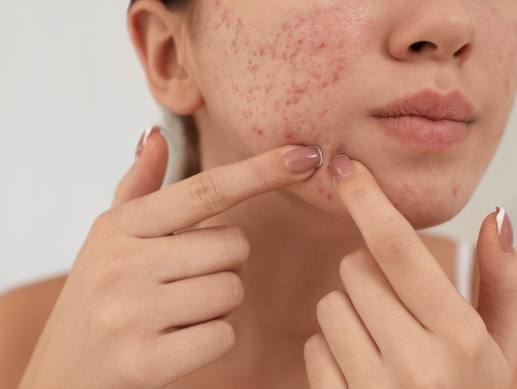 Pitting (Acne Scars): When Your Skin Keeps Souvenirs from Past Battles