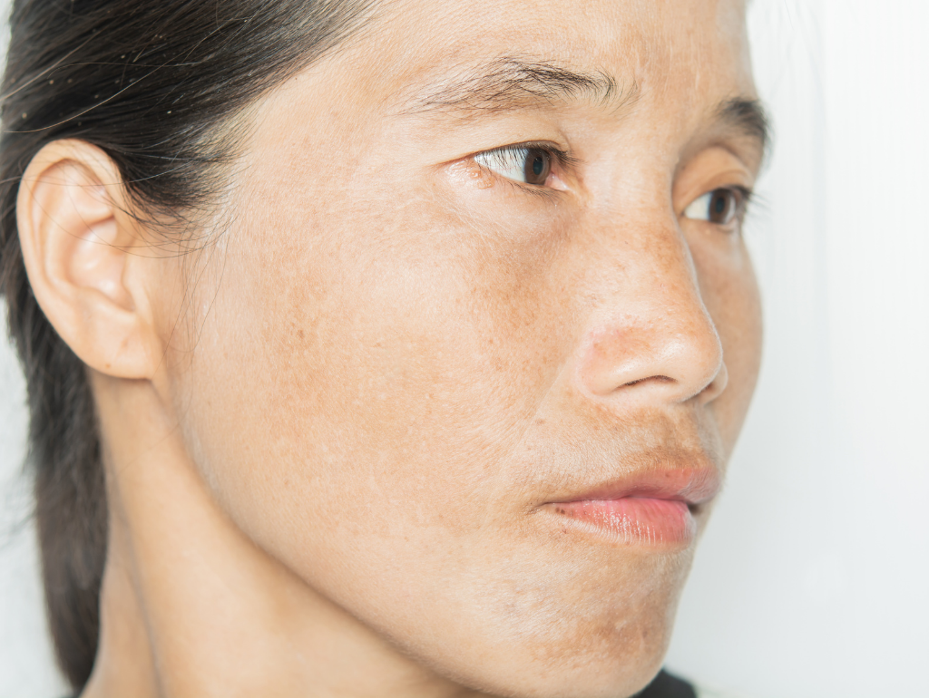 Sun Spots: When Years of Sunshine Come Back to Visit