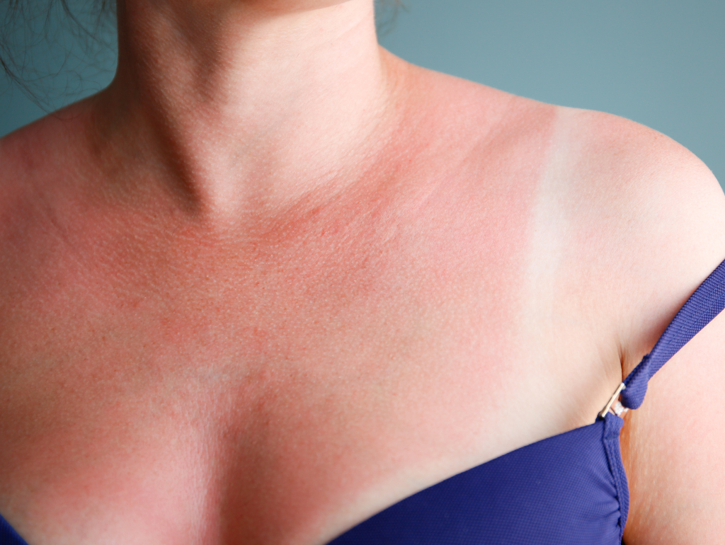 The Impact of Sun Exposure on Skin Tone