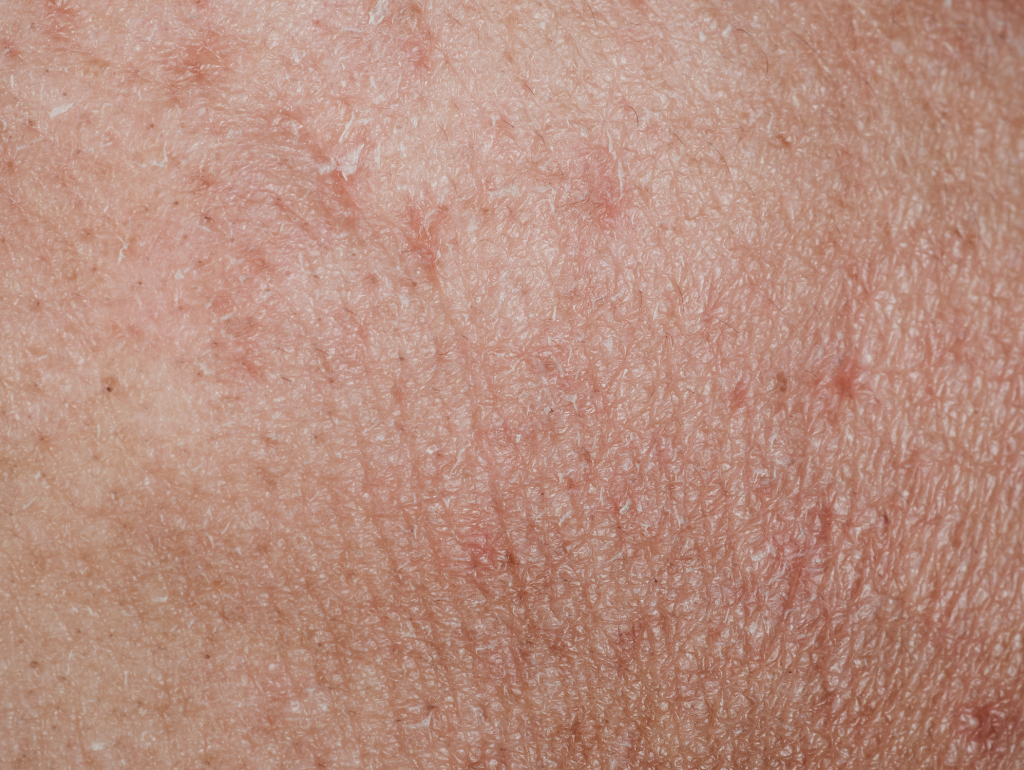 Rough Texture: When Your Skin Feels Like Sandpaper