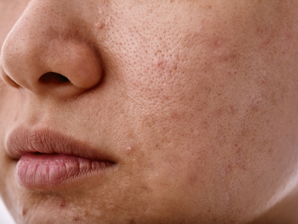 Uneven Skin Texture: When Your Skin Can't Decide What It Wants to Be